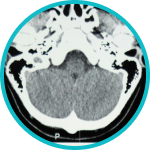 Cranial Navigation System for Image-Guided Surgery 5 Biopsies