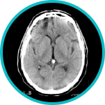 Cranial Navigation System for Image-Guided Surgery 3 Epilepsy