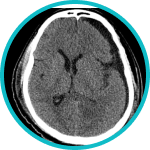 Cranial Navigation System for Image-Guided Surgery 4 Hematoma