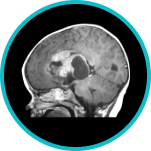 Cranial Navigation System for Image-Guided Surgery 1 Tumor